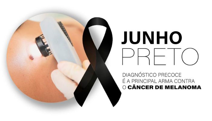 Diagnóstico precoce é a principal arma contra o melanoma, tipo mais agressivo de câncer de pele